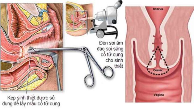 4 bước trong quy trình sàng lọc ung thư cổ tử cung cơ bản