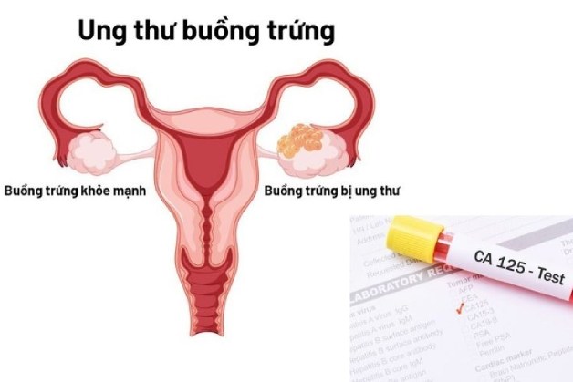 4 chỉ số tầm soát ung thư phổ biến hiện nay, bạn nên biết