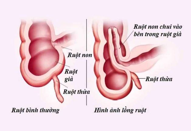 4 Dấu hiệu nhận biết sớm bệnh lồng ruột ở trẻ em