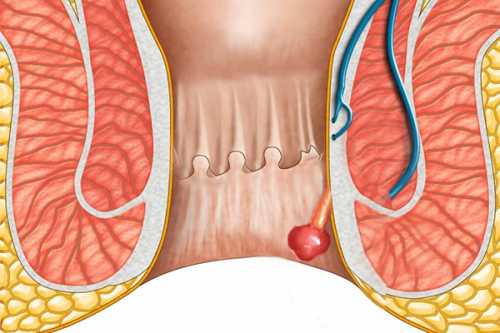 4 dấu hiệu polyp hậu môn và cách điều trị hiệu quả