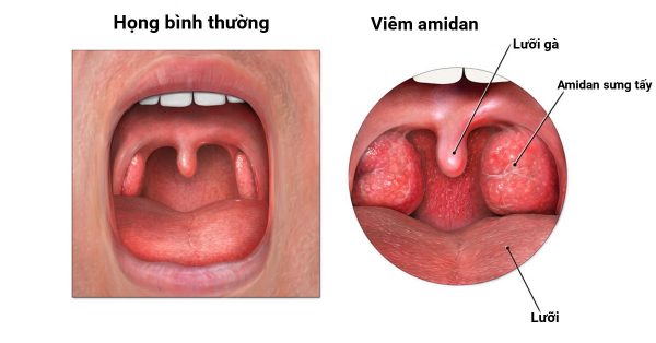 4 điều ba mẹ cần lưu ý khi cắt amidan cho trẻ