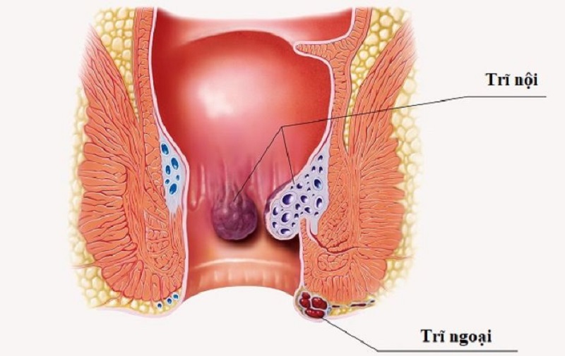 4 Điều biết trước khi sử dụng viên thuốc đặt trĩ