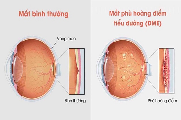 4 Điều cần biết về bệnh phù võng mạc ở người tiểu đường