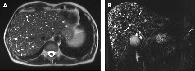 4 điều cần biết về kỹ thuật chụp MRI gan