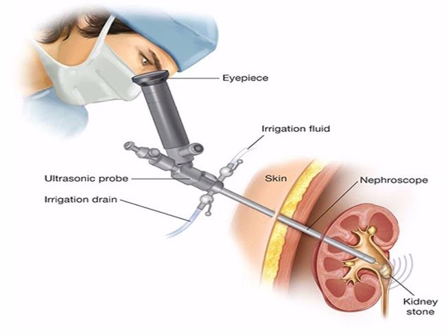 4 điều cần biết về phương pháp tán sỏi qua da