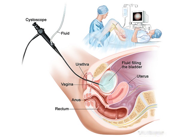 4 lợi ích của phương pháp tán sỏi ngược dòng bằng laser