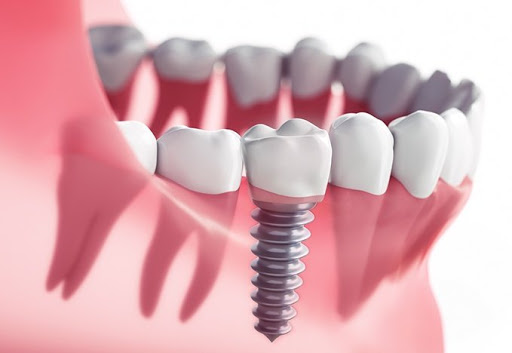 4 lưu ý quan trọng sau khi cấy ghép implant