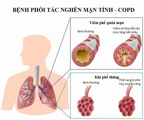 4 nguyên nhân chính gây viêm phổi tắc nghẽn mạn tính