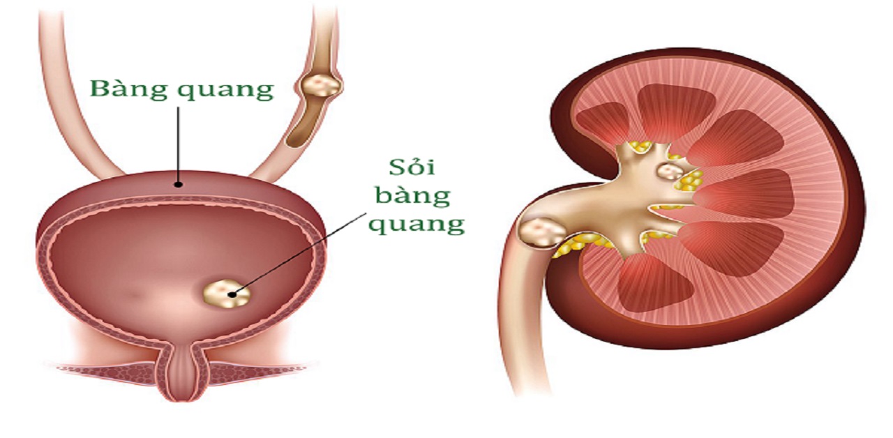 4 nguyên nhân gây sỏi bàng quang bạn nên biết