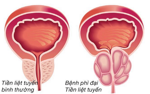 4 nguyên nhân gây sỏi bàng quang bạn nên biết