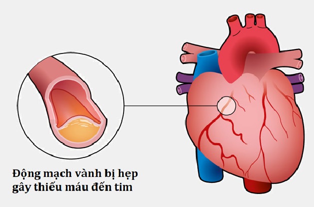 4 nguyên nhân thiếu máu cơ tim phổ biến nhất