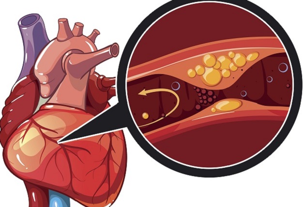 4 nguyên nhân thiếu máu cơ tim phổ biến nhất