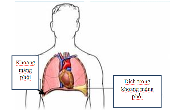 4 nhóm nguyên nhân tràn dịch màng phổi đe dọa tính mạng