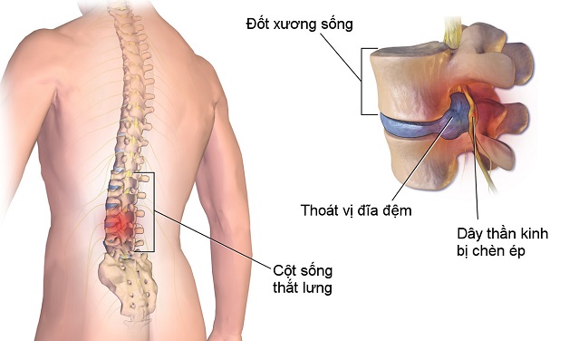 4 phương pháp chụp thoát vị đĩa đệm cột sống thắt lưng