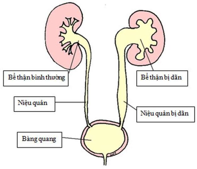 4 phương pháp điển hình điều trị hẹp niệu đạo