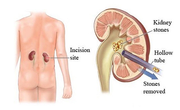 4 phương pháp phẫu thuật nội soi lấy sỏi điều trị sỏi tiết niệu