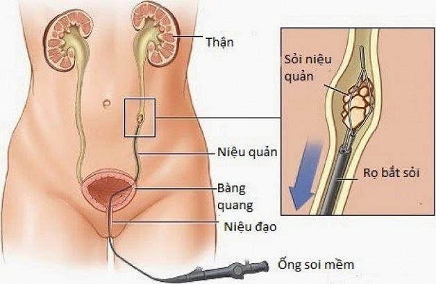 4 phương pháp phẫu thuật nội soi lấy sỏi điều trị sỏi tiết niệu