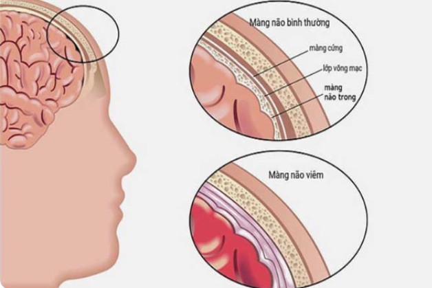 4 thông tin cần biết về vắc xin viêm màng não mủ