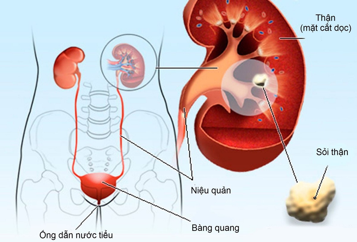 4 thông tin về sỏi niệu quản và phương pháp điều trị