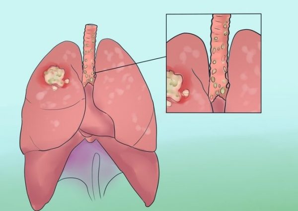 5 bệnh ung thư gây tử vong cho nữ giới nhiều nhất