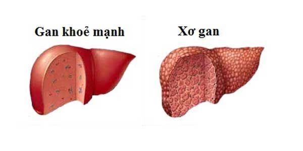 5 biến chứng nguy hiểm của bệnh xơ gan bạn cần biết