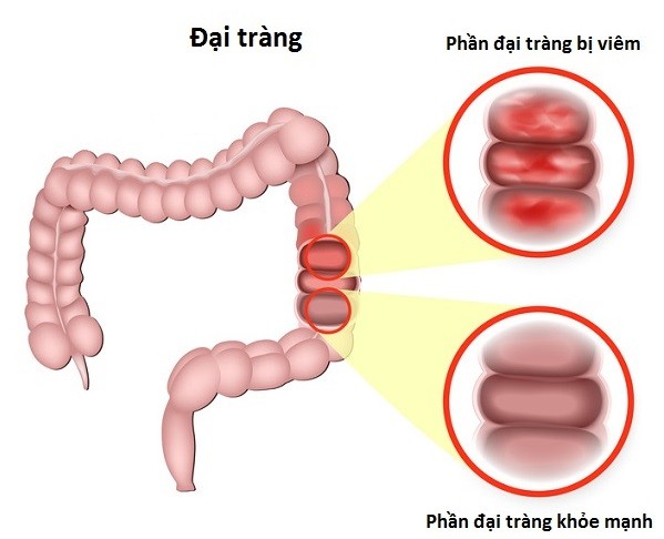 5 biến chứng nguy hiểm của viêm đại tràng mạn tính