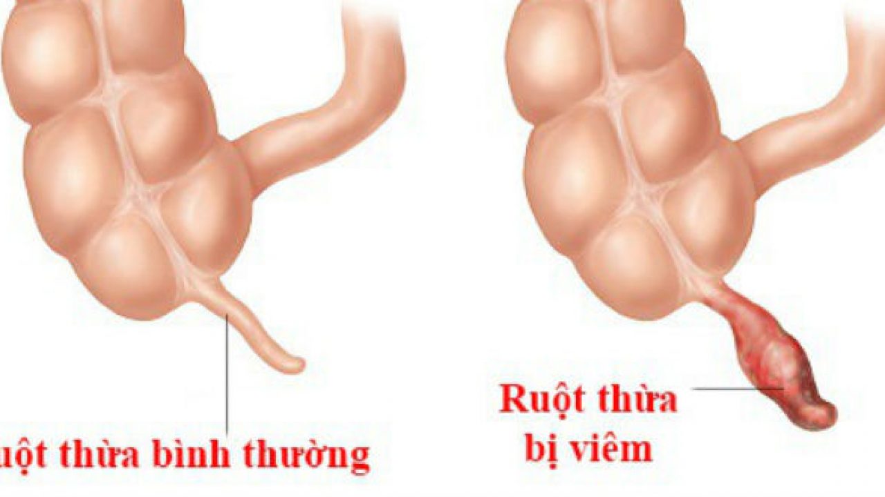 5 biến chứng sau phẫu thuật viêm ruột thừa cần lưu ý