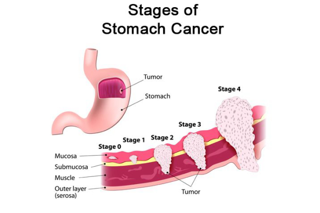 5 biểu hiện ung thư dạ dày sớm cần lưu ý