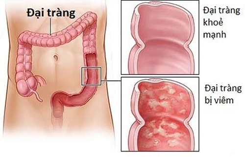 5 dấu hiệu giúp nhận biết bệnh viêm đại tràng từ sớm