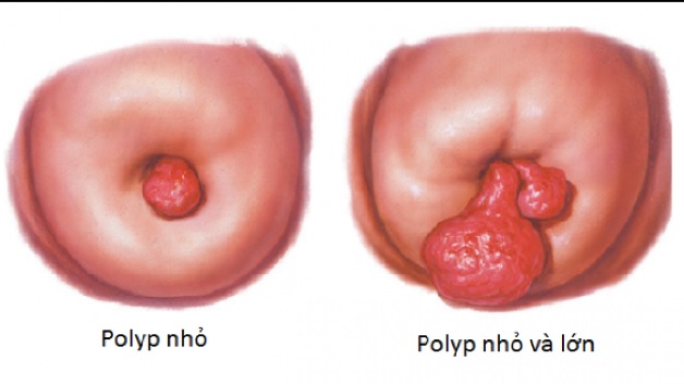 5 dấu hiệu polyp cổ tử cung điển hình nhất chị em nên lưu ý