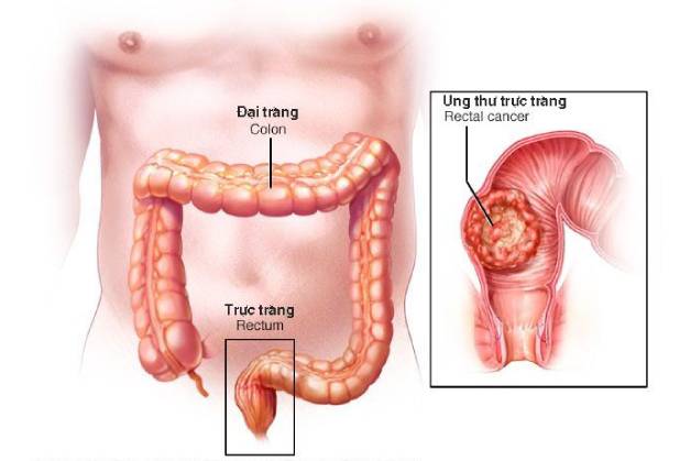 5 dấu hiệu ung thư trực tràng bạn cần biết