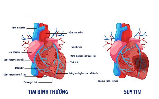 5 Điều bạn nên biết về hội chứng suy tim