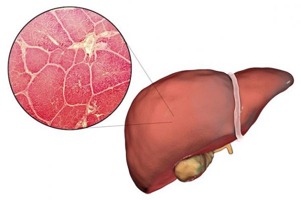 5 điều cần biết về bệnh vôi hóa gan