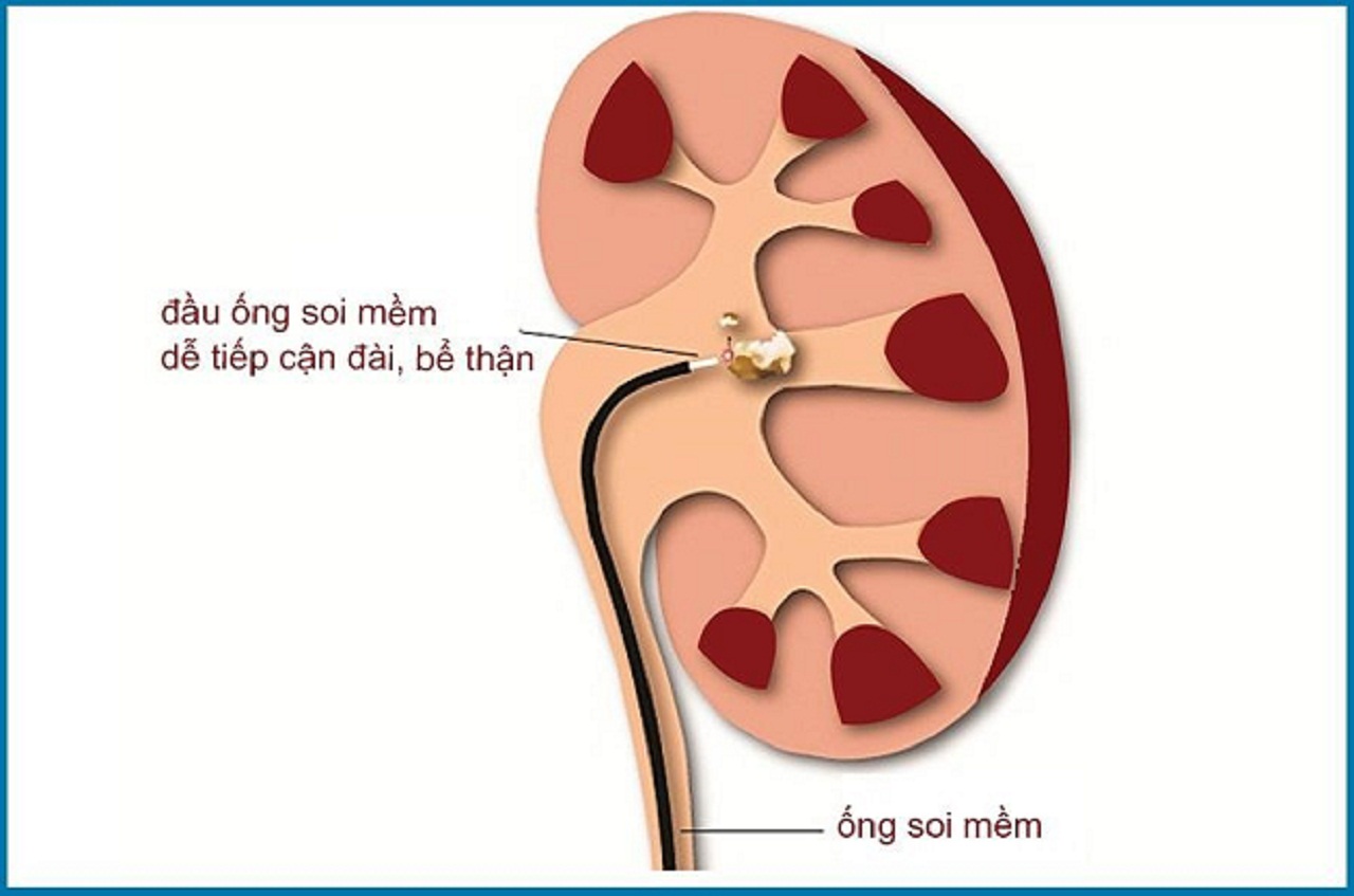 5 điều cần phải biết về tán sỏi thận bằng ống mềm