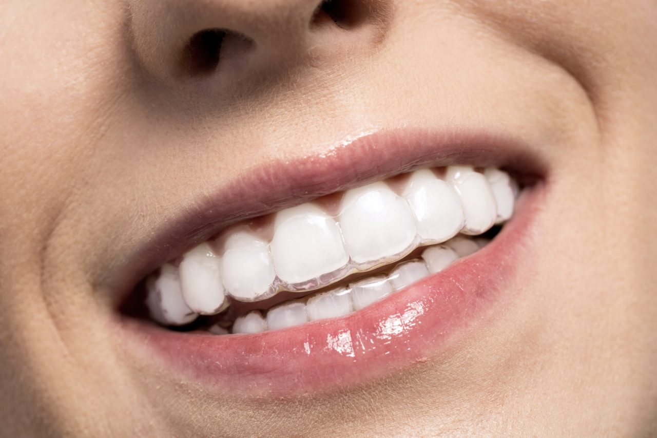 5 điều không thể bỏ qua về nắn chỉnh răng bằng invisalign