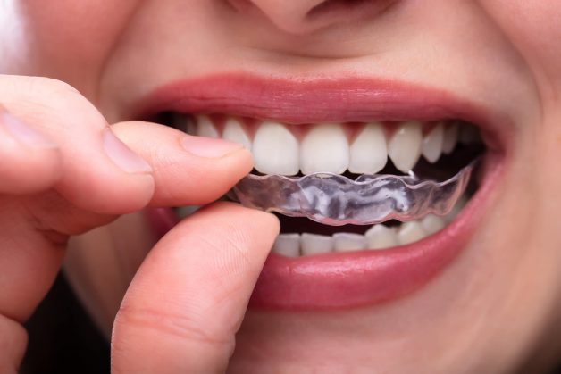 5 điều không thể bỏ qua về nắn chỉnh răng bằng invisalign