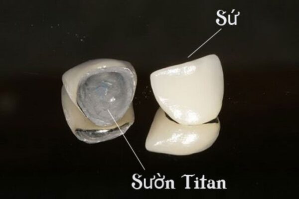 5 Điều nhất định phải biết trước khi bọc răng sứ titan