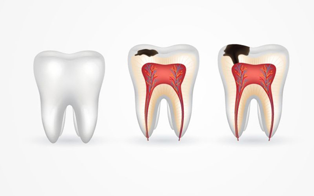 5 loại răng sâu phổ biến và cách điều trị