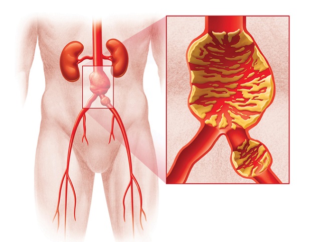 5 loại xơ vữa động mạch phổ biến và triệu chứng nhận biết