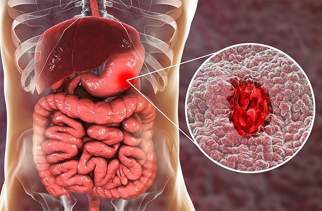 5 nguyên nhân bị viêm loét dạ dày phổ biến 