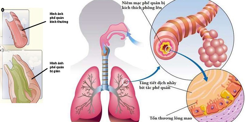 5 nguyên nhân gây giãn phế quản