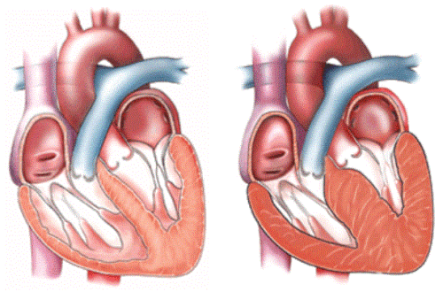 5 nguyên nhân hàng đầu gây đột tử ở nam giới