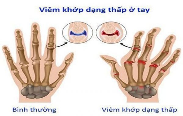 5 nguyên nhân khiến tay bị sưng phù và đau thường gặp