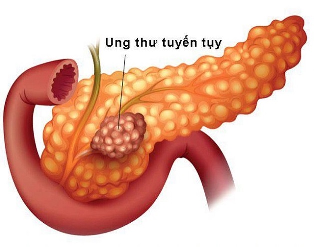 5 Nguyên nhân ung thư tuyến tụy bạn cần biết