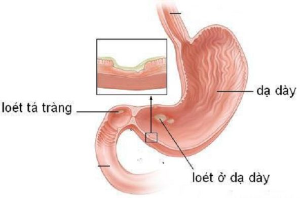 5 Nguyên nhân viêm loét dạ dày không nên chủ quan bỏ qua