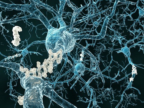 5 nhầm lẫn về bệnh Alzheimer