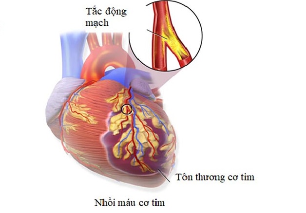 5 type nhồi máu cơ tim và những đặc điểm cơ bản