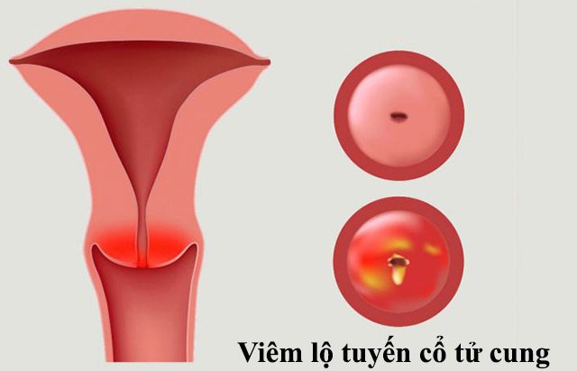 6 bệnh lý có thể gặp khi khí hư có mùi chua