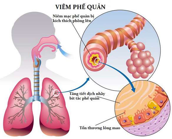 6 bệnh viêm phổi, viêm phế quản thường gặp nhất