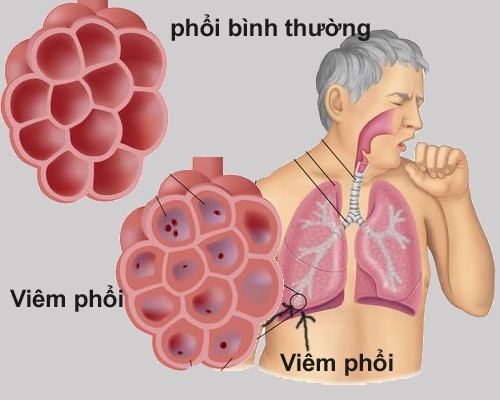 6 bệnh viêm phổi, viêm phế quản thường gặp nhất